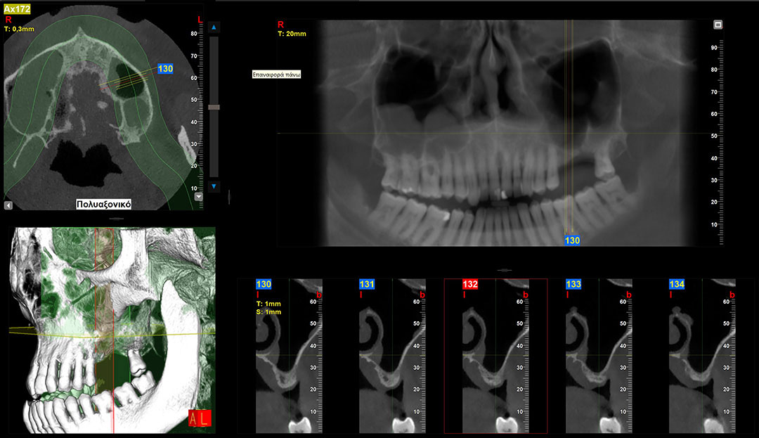 Οδοντιατρική Αξονική Τομογραφία CBCT – banikas-omfs.gr CBCT αξονική τομογραφία γνάθου - Γναθοχειρουργός Κατερίνη Βασίλης Μπανίκας